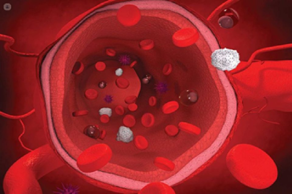 Arteriosclerosis, A degenerative arterial disease