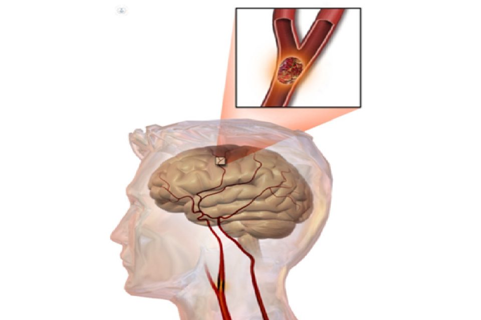 Stroke