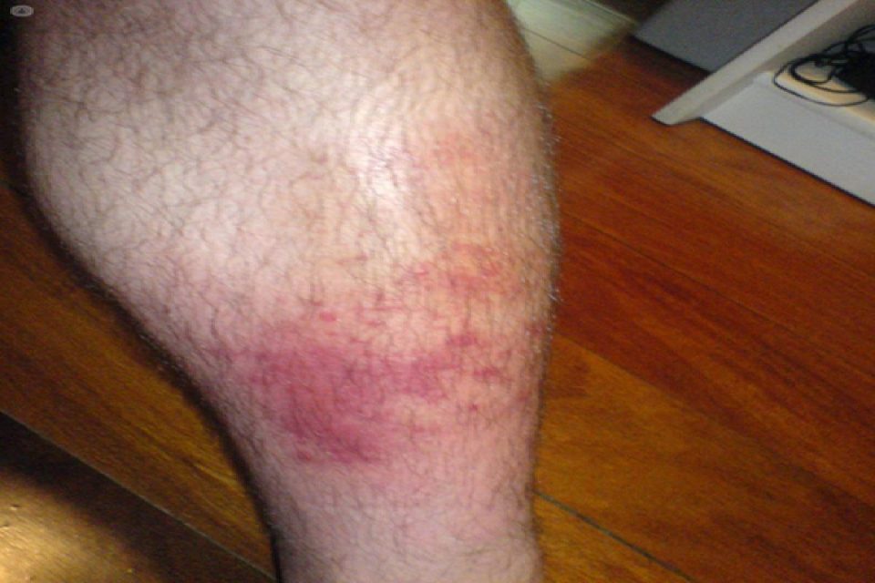 Phlebitis