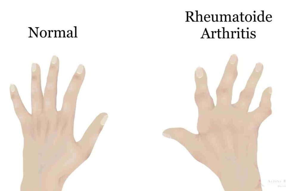 Rheumatism_ What it is, Symptoms, Treatment