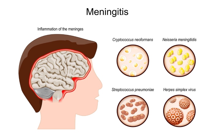 Fungal Meningitis Write for Us