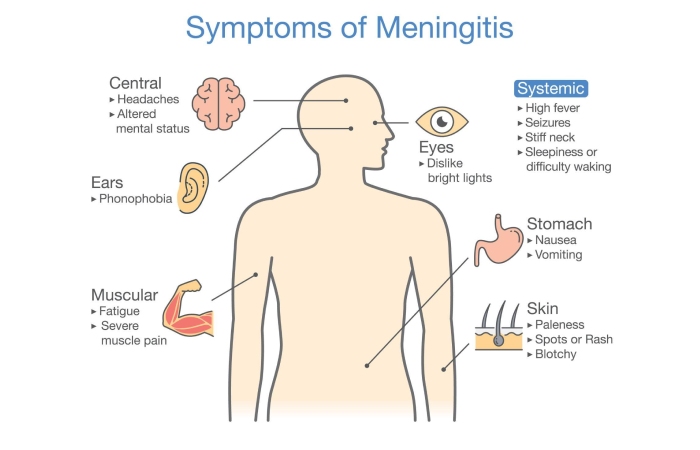 Signs and symptoms of fungal Meningitis include: