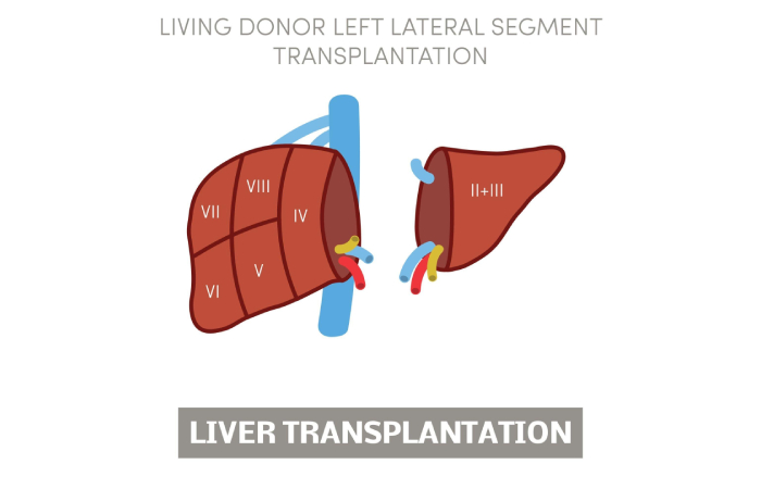 Liver Transplant Write for Us