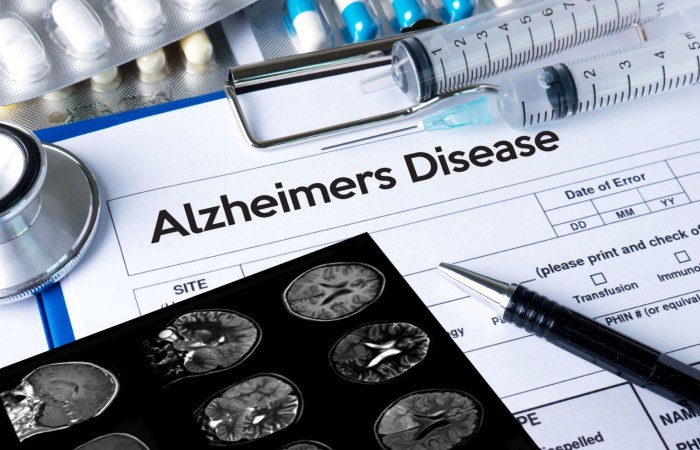 Alzheimer's Disease Write for Us