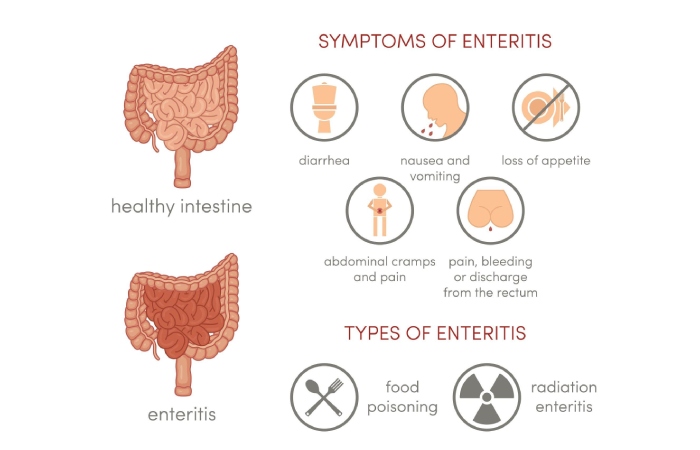 Amebiasis Intestinal Write for Us