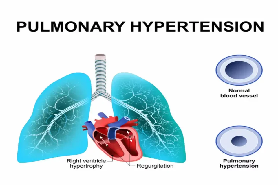 Arterial Hypertension