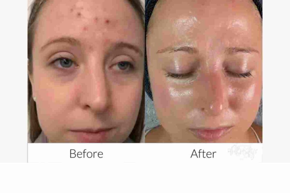 Microneedle_ What it is and What are Its Results