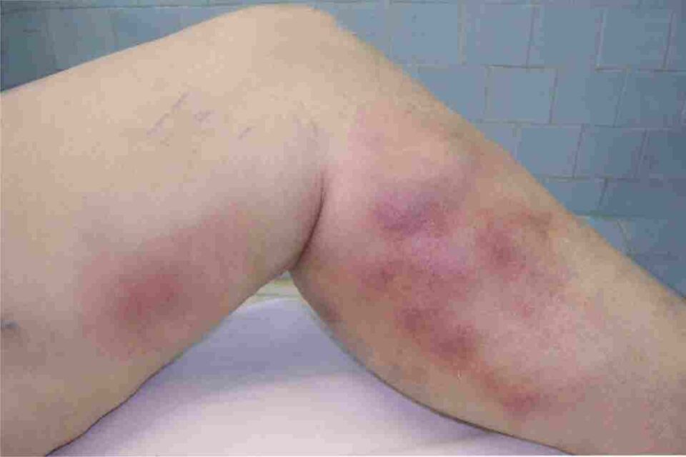 Phlebitis