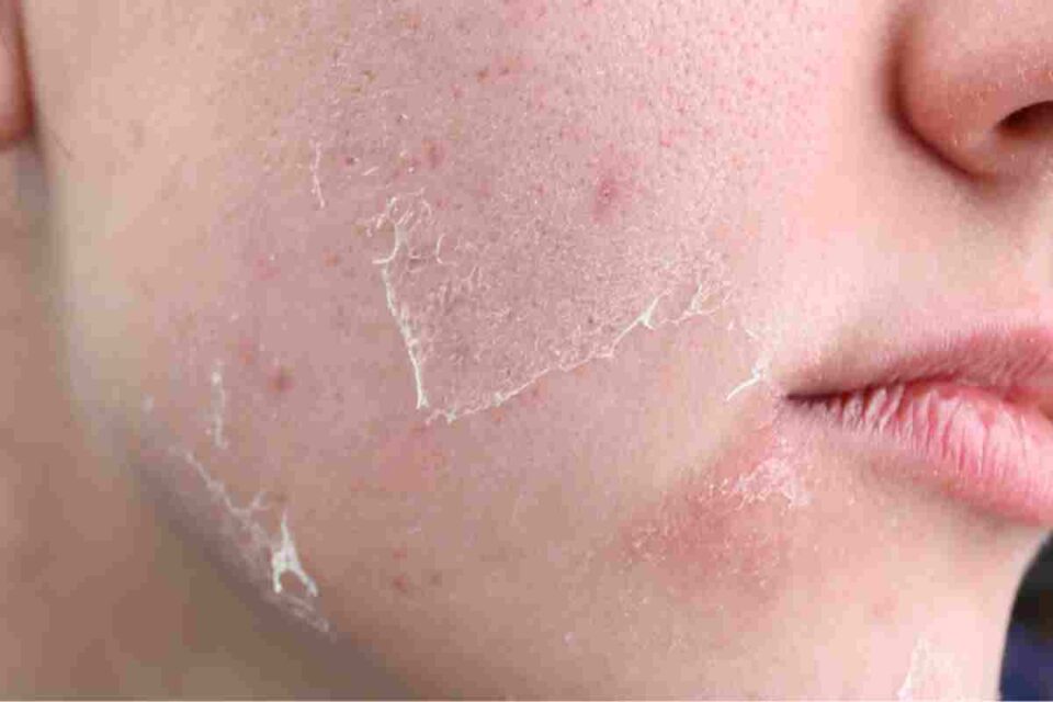 dry skin