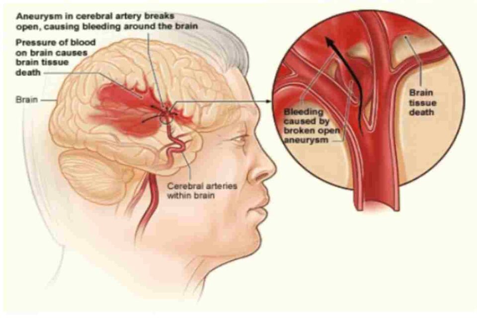 Blood Disorders That Lead to Stroke